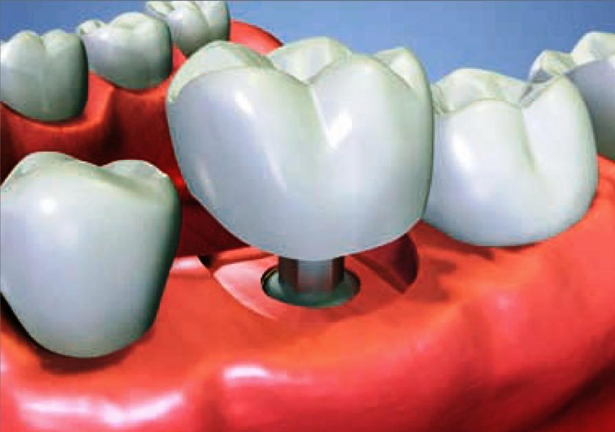 Zubní lékař Louny - implantát