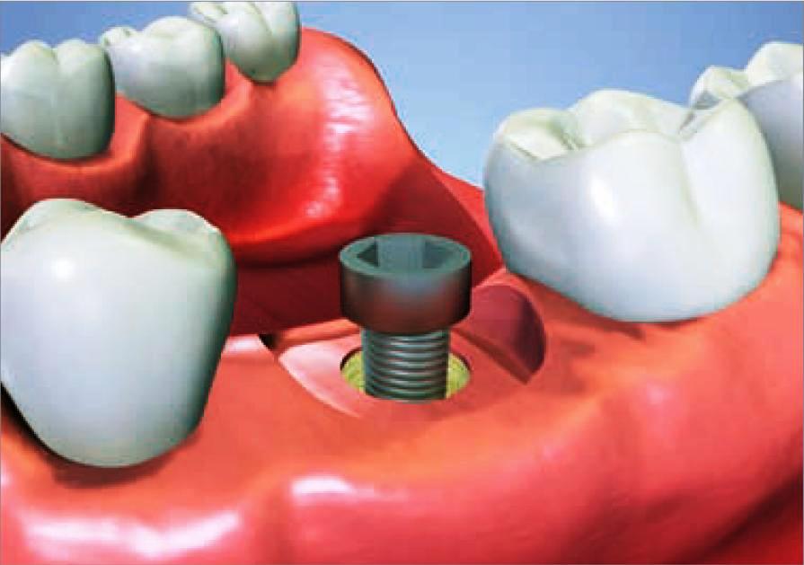 Zubní lékař Louny - implantát